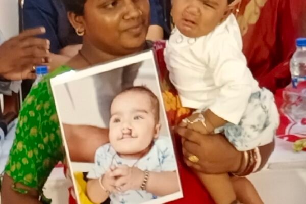 Free Cleft Surgery Facility To Children And Young Adults Of West Bengal