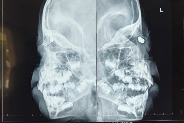 Sankara Eye Hospital, Hyderabad, Successfully Treats Rare Orbital Air Gun Pellet Eye Injury in Three-Year-Old Child