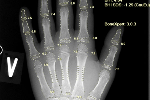 Aarthi Scans & Labs Rolls Out AI-Based Bone Age Technology across 100 Centres in India